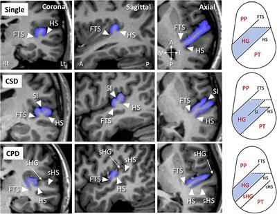 Heschl’s Gyrus Duplication Pattern in Individuals at Risk of Developing Psychosis and Patients With Schizophrenia